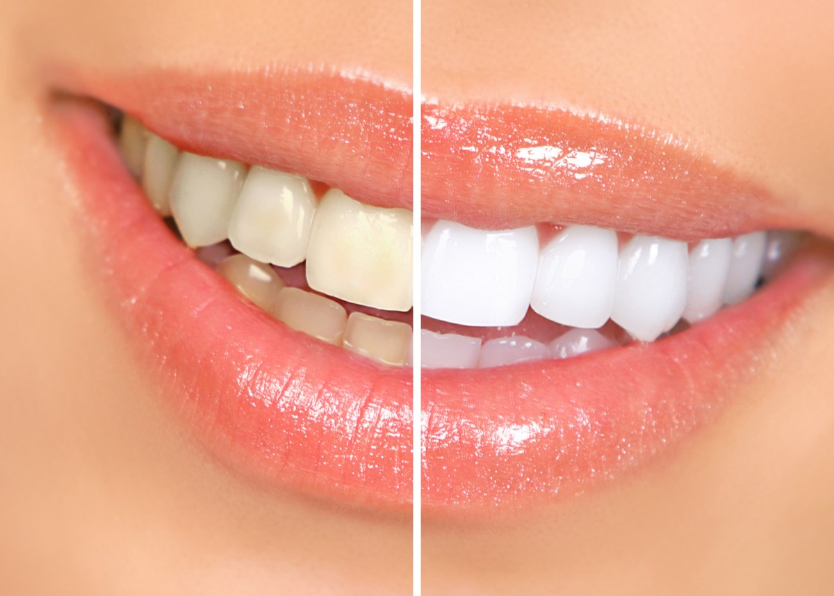 7 Steps to Choosing a Cosmetic&nbsp;Dentist