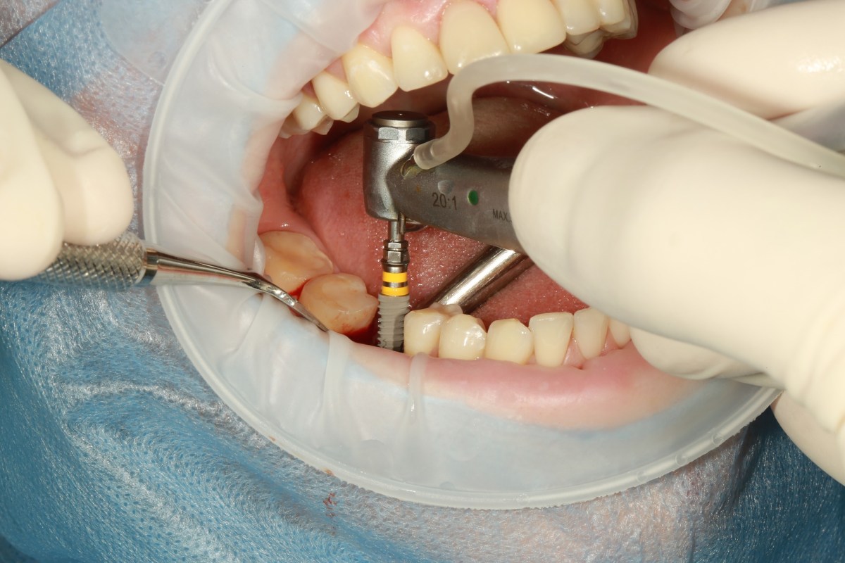 Three Top Reasons Why Dental Implants&nbsp;Fail