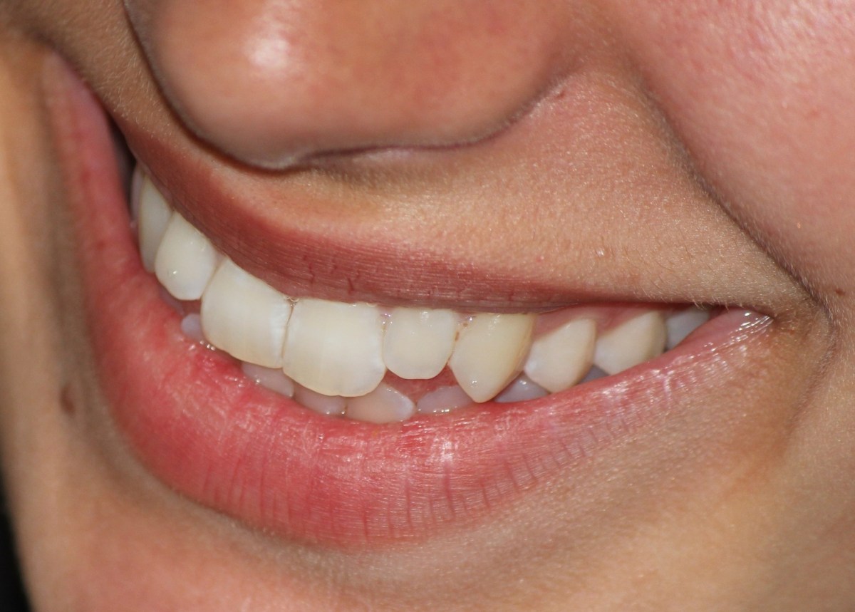Teeth Whitening Misconceptions You Should Not&nbsp;Believe