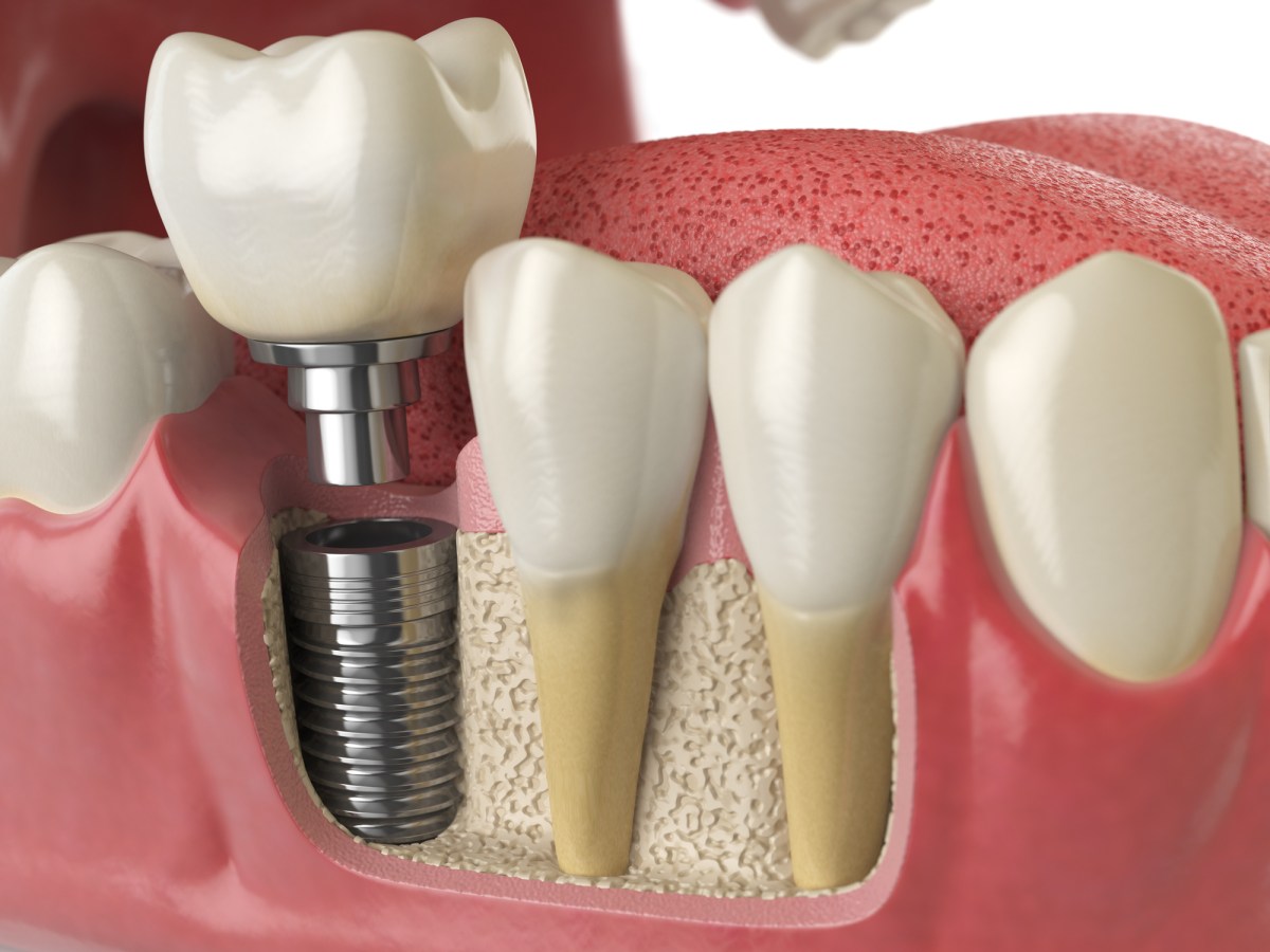 Understanding Dental Implants and the Complications of&nbsp;Surgery
