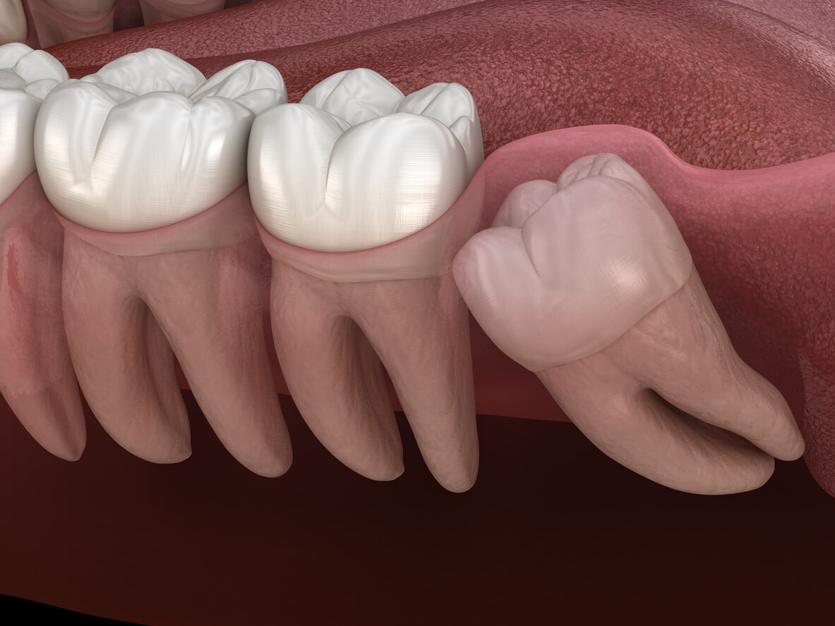 Recovery From Wisdom Teeth Severe&nbsp;Complications