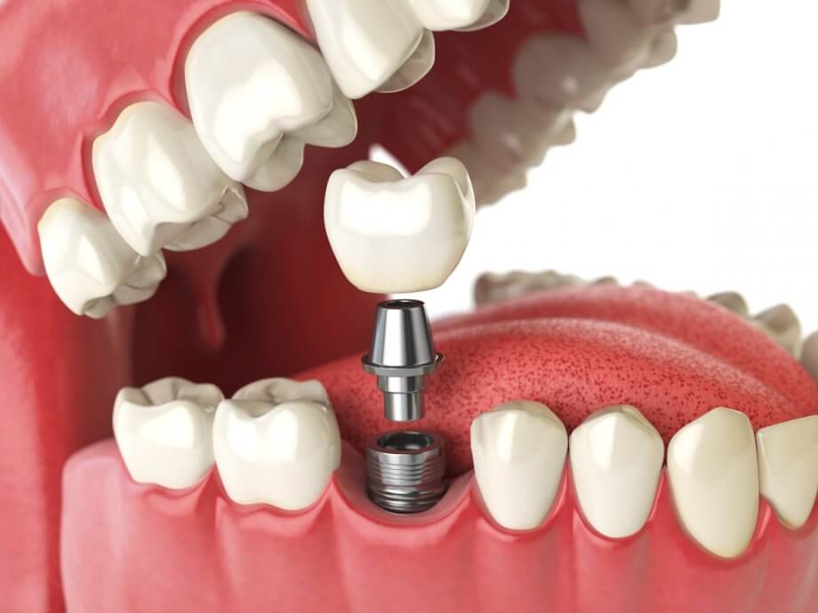 Dental Mini-implants – An Easy Alternative to bridgework and&nbsp;Implants
