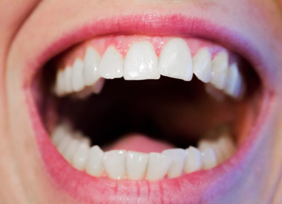 Dental Gum Lifts – What Are&nbsp;They?