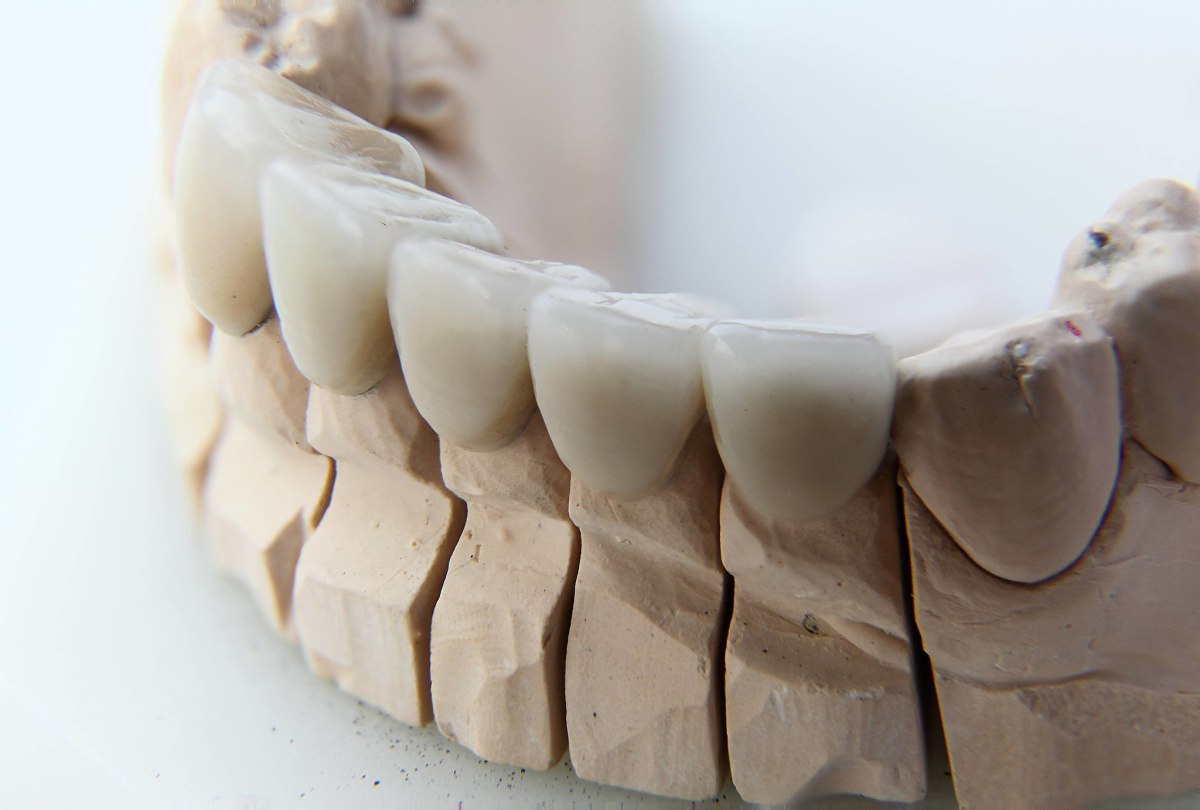 Dental Veneers – The Affordable Cosmetic Dental Work&nbsp;Option